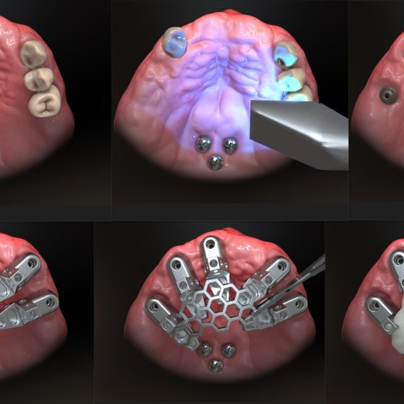 OPTISPLINT Kit 4 Corpuri de Scanare