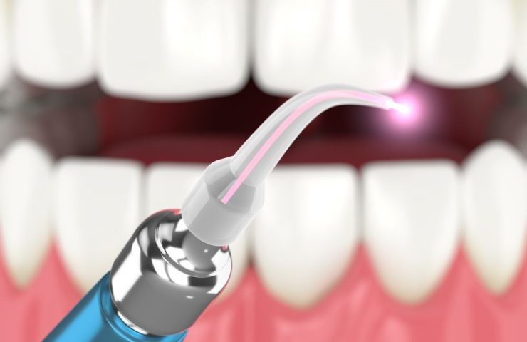 laserul-dentar-cheia-pentru-tratamente-fara-durere-si-fara-frica
